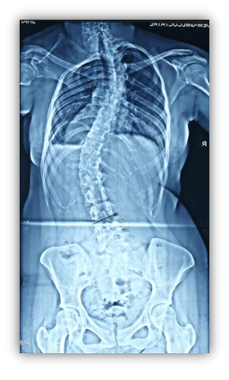 scoliosis symptoms and cause
