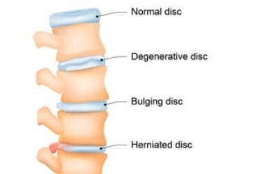 Degenerative Disc Disease: Causes, Symptoms & Treatment