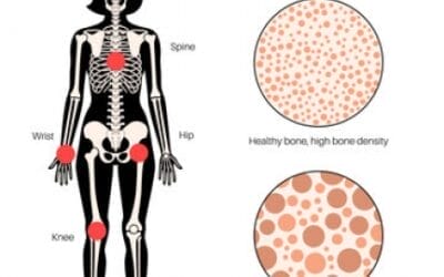 Osteoporosis and Spine Fractures in Women