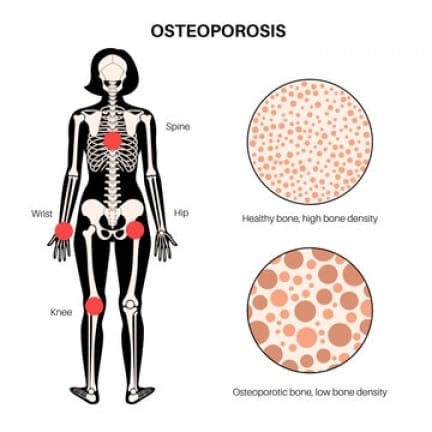 Osteoporosis Fracture