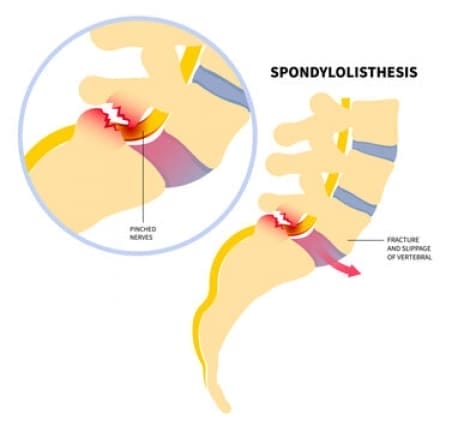 Spondylolisthesis Causes, Symptoms & Treatments