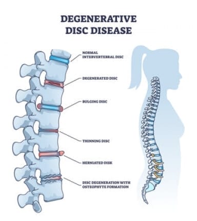 Degenerative Disc Disease: Causes, Symptoms & Treatment