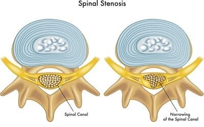 Spinal Stenosis: Causes, Symptoms, and Treatment
