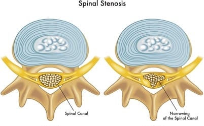 Spinal Stenosis in Women